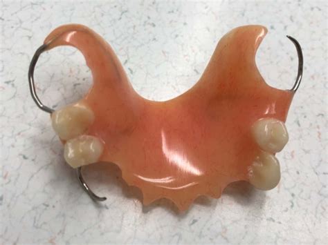 partial castacrylic dentures flippers custom options grantham