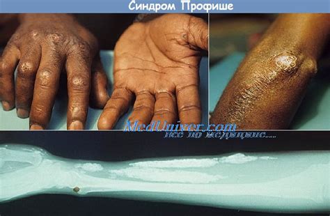 Первичный и вторичный системный амилоидоз. Кальциноз кожи