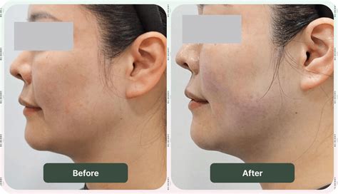 sofwave     visible results