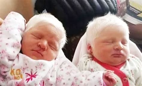 albino twins born  argentina  leave   awe
