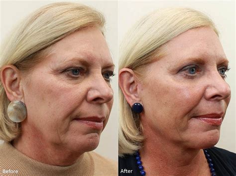 dr darm aesthetic medicine blog natural  facelift
