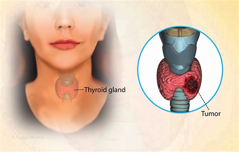 Health Condition : Symptoms, Causes, Treatment and More