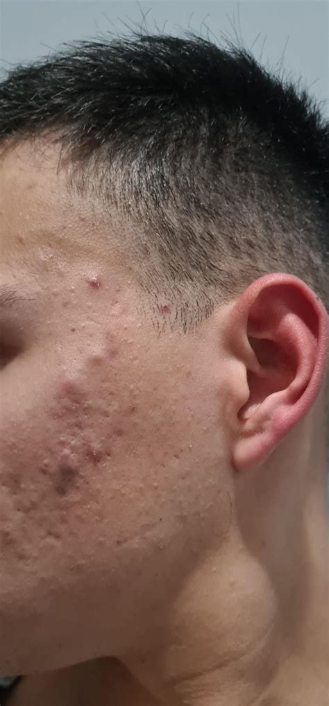 Espinha Interna Na Vagina