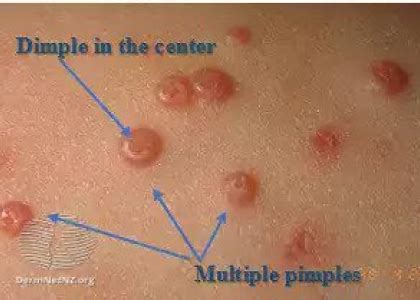 molluscum contagiosum penile shaft