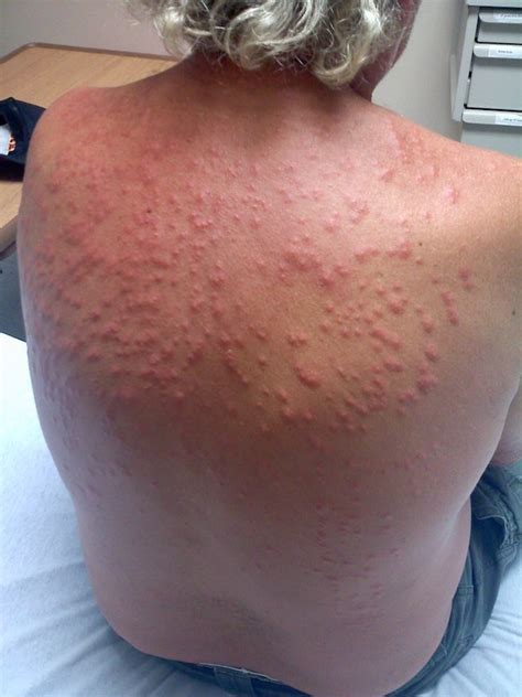 Bed Bug Allergic Reaction at Amy Macartney blog