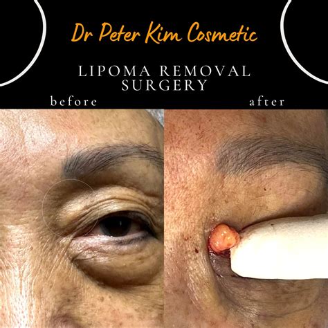 Lipoma surgery, Treatment, Removal Sydney - Dr Lipoma Popper Sydney ...