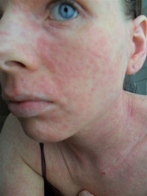 I Have Eczema: Eczema Herpeticum No.8