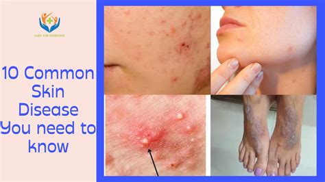 The 10 Most Common Skin Diseases And How To Treat Them | Images and Photos finder