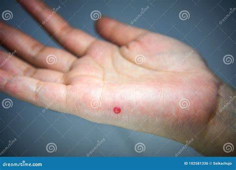 Bolha De Sangue Na Mao