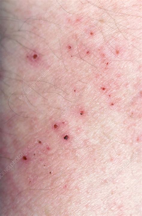Scabies - Stock Image - C014/4367 - Science Photo Library