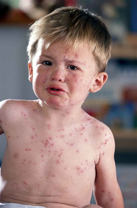 Can Antibiotics Cause a Rash on My Baby? | 2bstronger.com