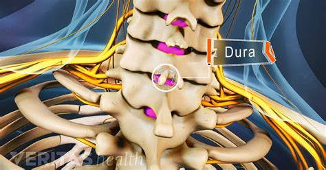 Cervical Epidural Steroid Injection Video