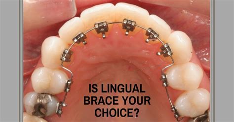 braces   teeth  morris rios blog