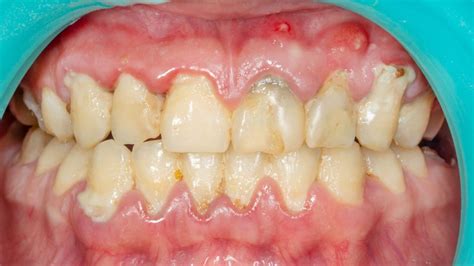 dental plaque smile stories
