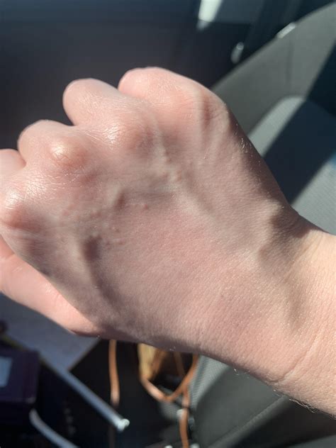 Dyshidrotic eczema from excessive hand washing :/ it’s only gotten