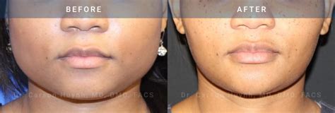 masseter muscle reduction archives radiance surgery aesthetic medicine