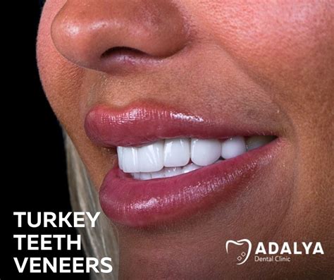 Turkey Teeth Veneers - Affordable Dental Veneer Price in Antalya