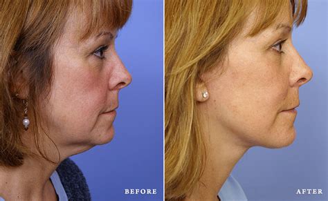 Lower Facelift | FacesFirst Cosmetic Surgery