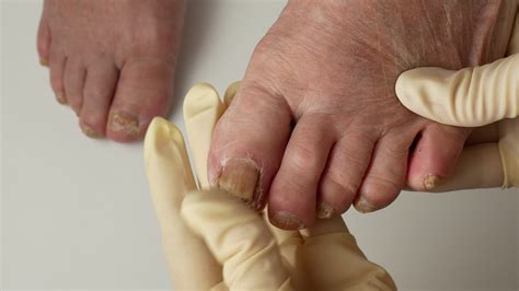 Toenail fungus. A podologist examines toenails affected by a fungal