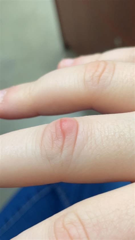 21F Bump On Finger Joint, Anyone Know What This Could Be? (More context