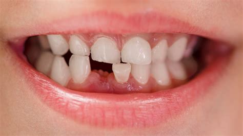 mitos  realidades sobre los dientes de leche clinica fernandez abarca
