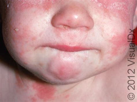 Seborrheic Dermatitis in Children: Causes, Symptoms, and Treatment