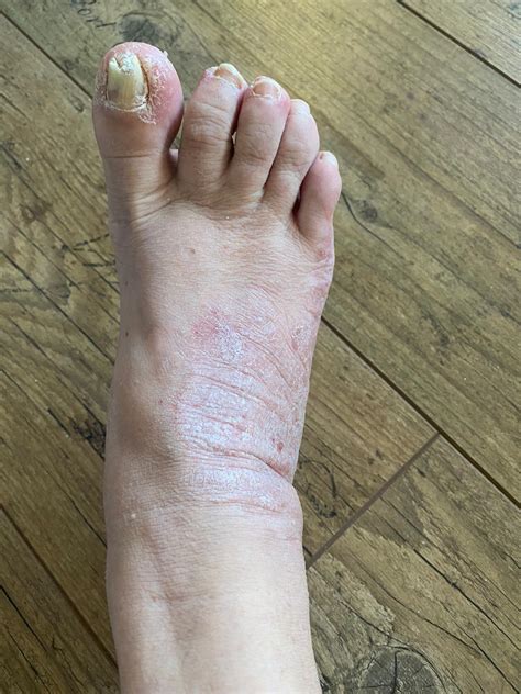 SAPHO syndrome | Eurorad