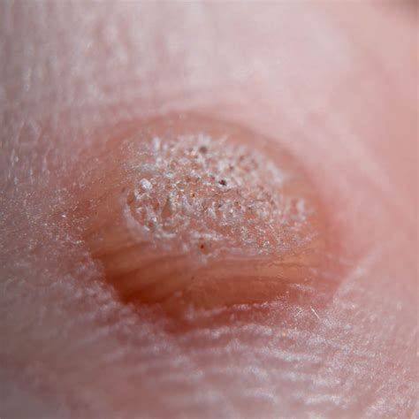 Wart & Verruca Removal| Devonshire Dermatology | London