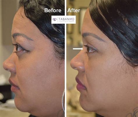 Graves Disease Before and After Gallery | Taban MD