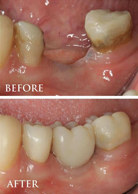 Smile Gallery | Before and After Periodontal Therapy