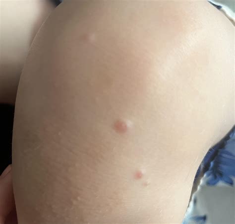 Bumps on knee : r/Dermatology