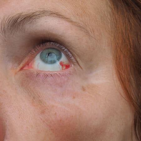 Photo of Subconjunctival hemorrhage or - ID:174771017 - Royalty Free ...