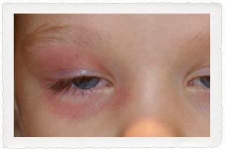 Pink Eye/Conjunctivitis — Dr. Joel's Clinic