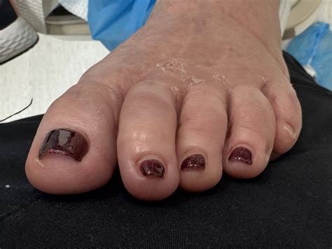 Hammertoe Before and After Photos | Northwest Surgery Center