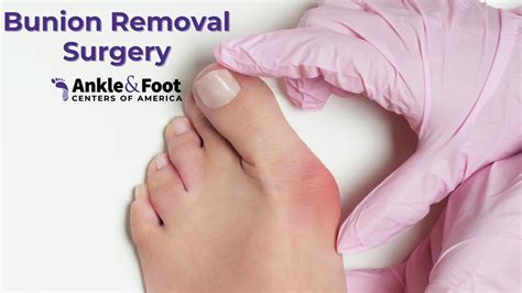 Bunion Removal – Bunionectomy to Non Invasive Bunion Surgery