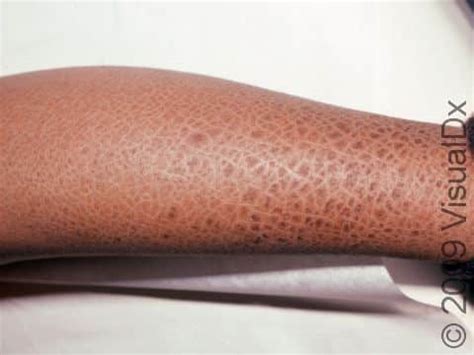 Scaly Skin (Ichthyosis Vulgaris) Condition, Treatments and Pictures for ...