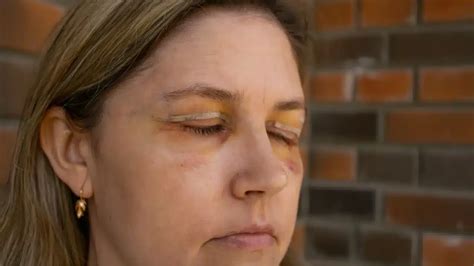 Blepharoplasty Recovery | What to Expect at Home