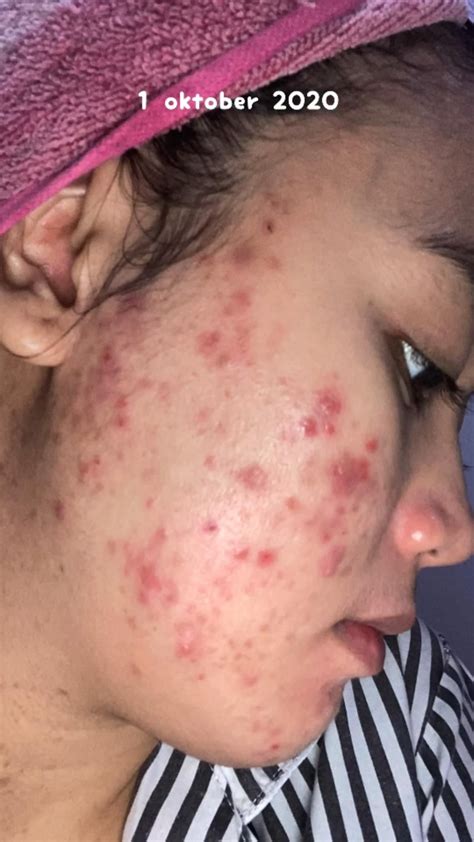 pcos hormonal acne  pcos diva  success story artofit