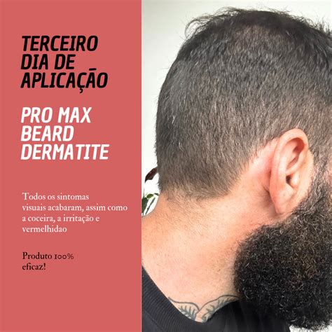 Coceira Quando Usa Minoxidil - Minoxidil Coceira: O que causa e como aliviar [Guia Rápido]