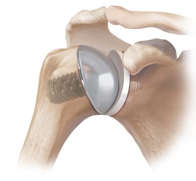 arthrex gelpi retractor  blunt tip ar