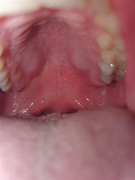 Any advice on what those two lumps on the roof of my mouth are : r
