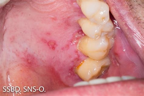 Oral Herpes Untreated at Dawn Boykins blog