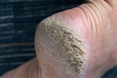 cracked heels dry skin  steady gait foot clinic  scarborough