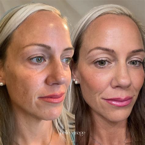 Restorative Sculptra Treatment in Burleson, TX | Visit Now