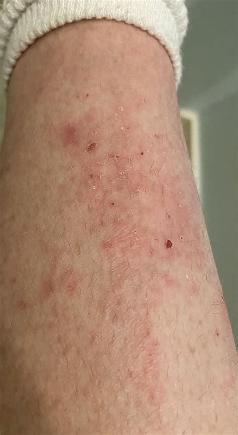 Rash on leg over a lipoma : r/DermatologyQuestions