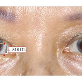 Lower lid real scleral show calculation. | Download Scientific Diagram