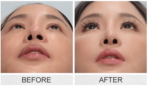 nasal tip surgery