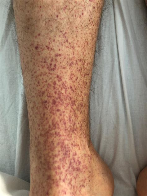 immune thrombocytopenic purpura  sarscov vaccine candelli
