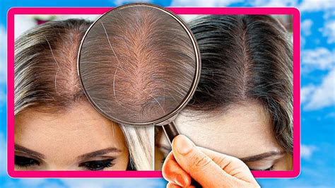 O Que Fazer Para Parar A Queda De Cabelo