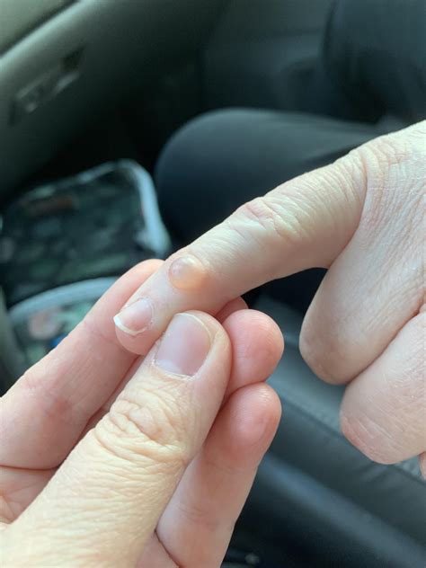 Digital Mucous Cyst on my mom’s pinky. Maybe this isn’t allowed because